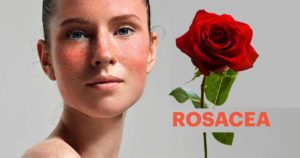 Rosacea-farmacia-cannone-vomero